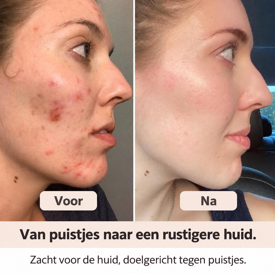 Noveau™ Puistjespleister op Rol